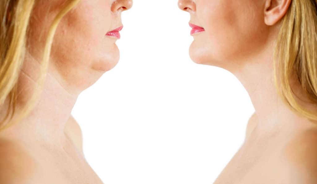 Double Chin treatment Greater London (Bromley) before and after results
