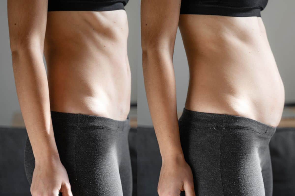 How long does diastasis recti take to improve Greater London (Bromley)?