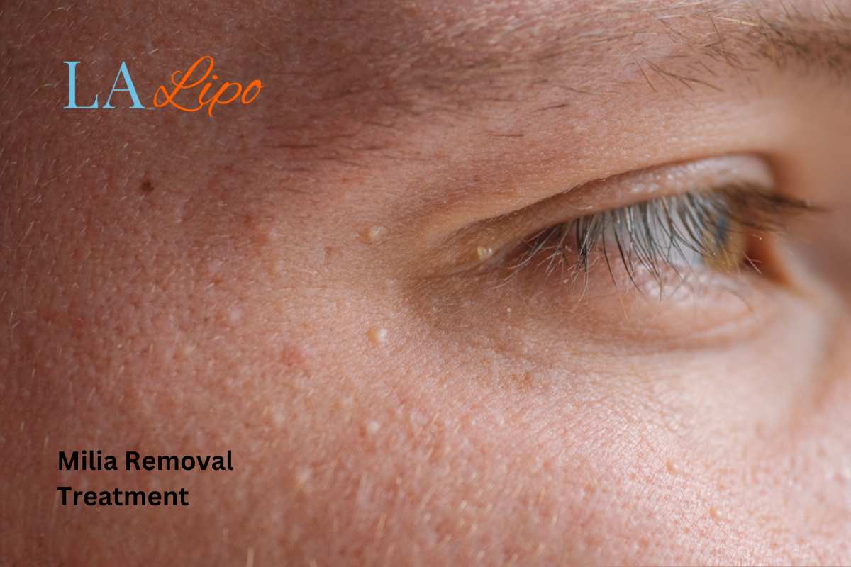 Cryopen Milia Removal: Is It the Easiest and Safest Option Greater London (Bromley)?