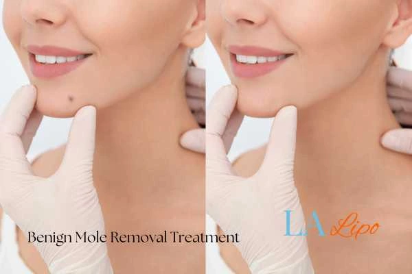 Before-and-after results following benign mole-removal treatment Greater London (Bromley)