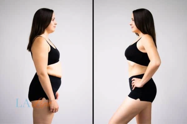 image of woman before and after results of LA-EMS Body Sculpting Greater London (Bromley) to help treat Diastasis recti