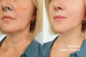 hi-fu for wrinkles Greater London (Bromley) before and after results