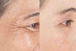Before and after results of woman - HI-fu wrinkles reduction treatment Greater London (Bromley)