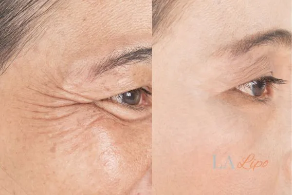 Before and after results of woman - HI-fu wrinkles reduction treatment Greater London (Bromley)