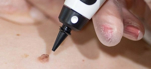 skin tag removal using cryopen Greater London (Bromley)