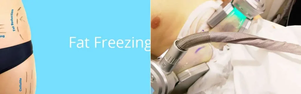 Fat freezing Greater London (Bromley) on multiple areas of the body