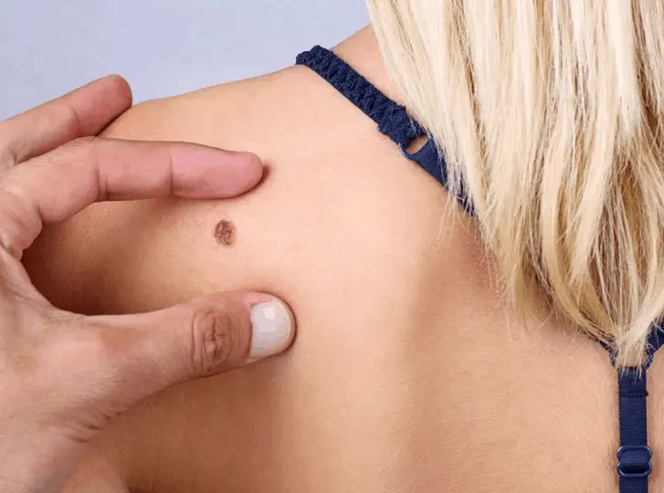 woman having mole removal Greater London (Bromley) consultation before treatment.