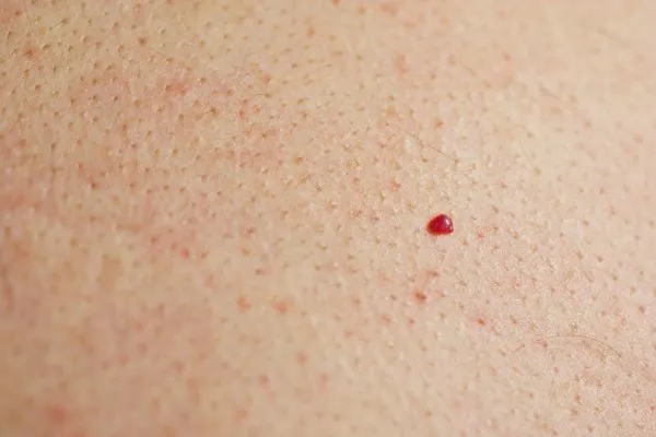 close up of a cherry angioma Greater London (Bromley)