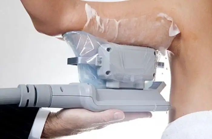 Picture of fat freezing Greater London (Bromley) on the upper arms.