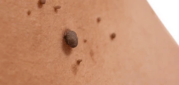 image of a skin tag Greater London (Bromley)