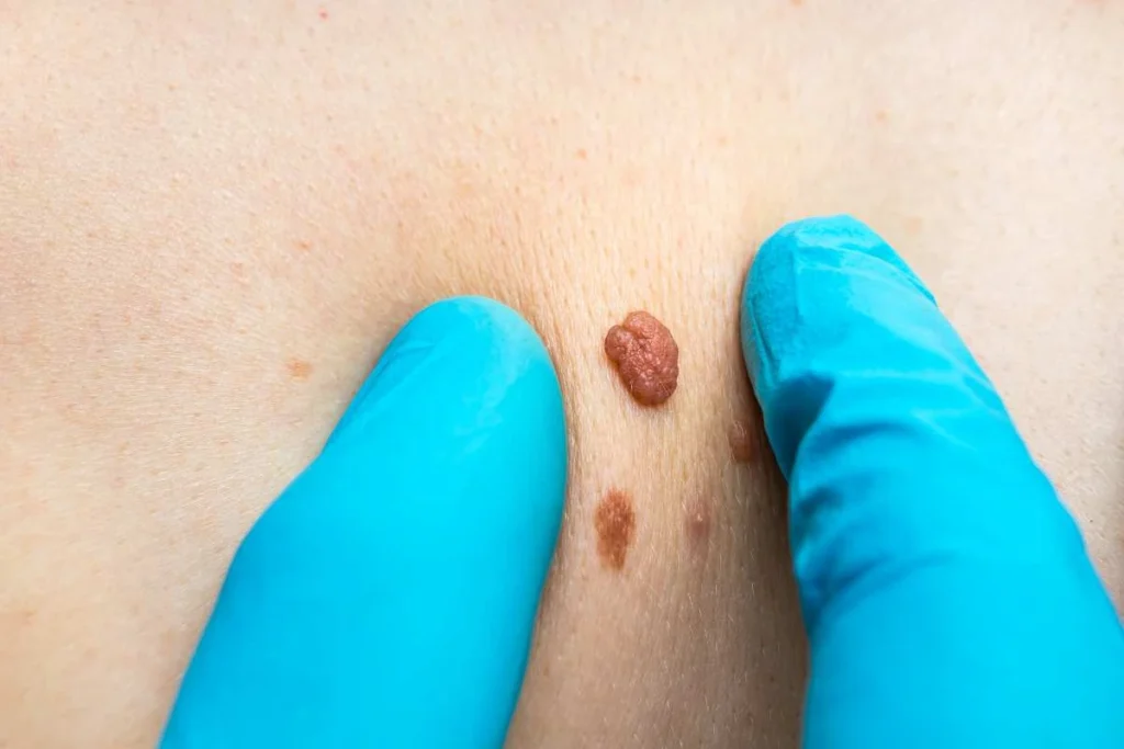 Consultant examining a skin tag Greater London (Bromley)