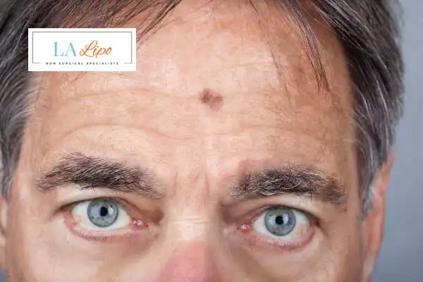 Solar Lentigo Removal Greater London (Bromley) image of man with mark on his forehead