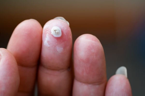 wart on person finger - cryotherapy to treat from LA LIPO Greater London (Bromley)
