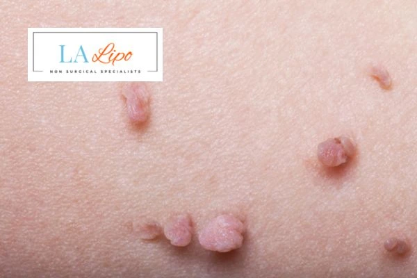 Does cryopen skin tag removal Greater London (Bromley) hurt? Find out now call our team today!