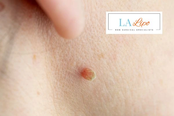 Book skin tag removal Greater London (Bromley) today speak to our team now!