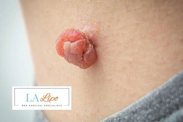 Interested in skin tag removal Greater London (Bromley)? Concerned about the pain? Find out more today!