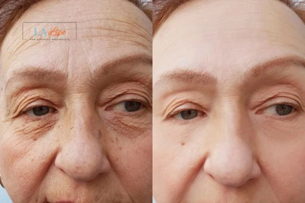 The powerful benefits of Morpheus8 Treatment Greater London (Bromley) - Call Our team today!