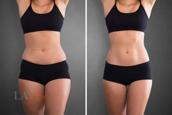 before and after results of non-surgical treatment to help a woman's body image and mental health Greater London (Bromley)