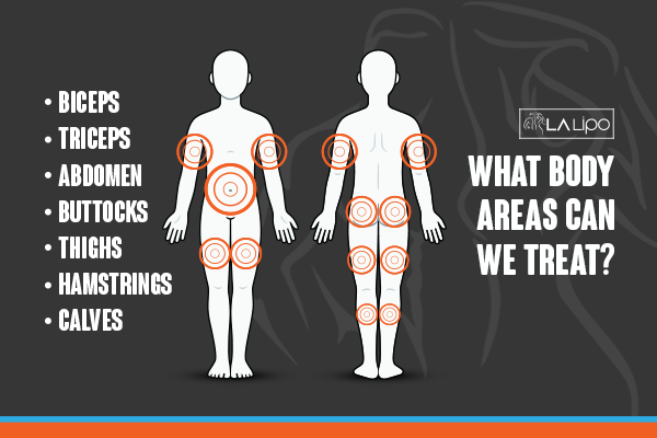 Diagram to show areas you can have LA-EMS Body Sculpting Treatment Greater London (Bromley)