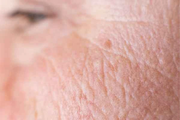 close up picture of a woman's face showing an age spot Greater London (Bromley)
