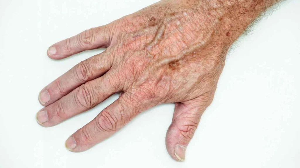 Male hand showing age spot Greater London (Bromley)