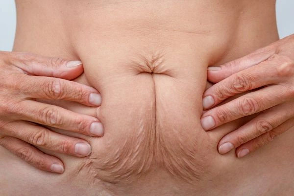 Should I Combine Diastasis Recti Treatment with Body Contouring for Better Results Greater London (Bromley)?